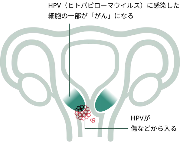 HPV (ヒトパピローマウイルス) に感染した細胞の一部が「がん」になる仕組み